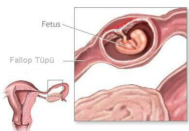 tpte yerlemi d gebelik