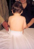 torticollis