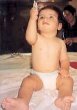 torticollis