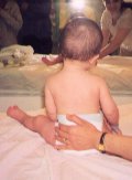 torticollis